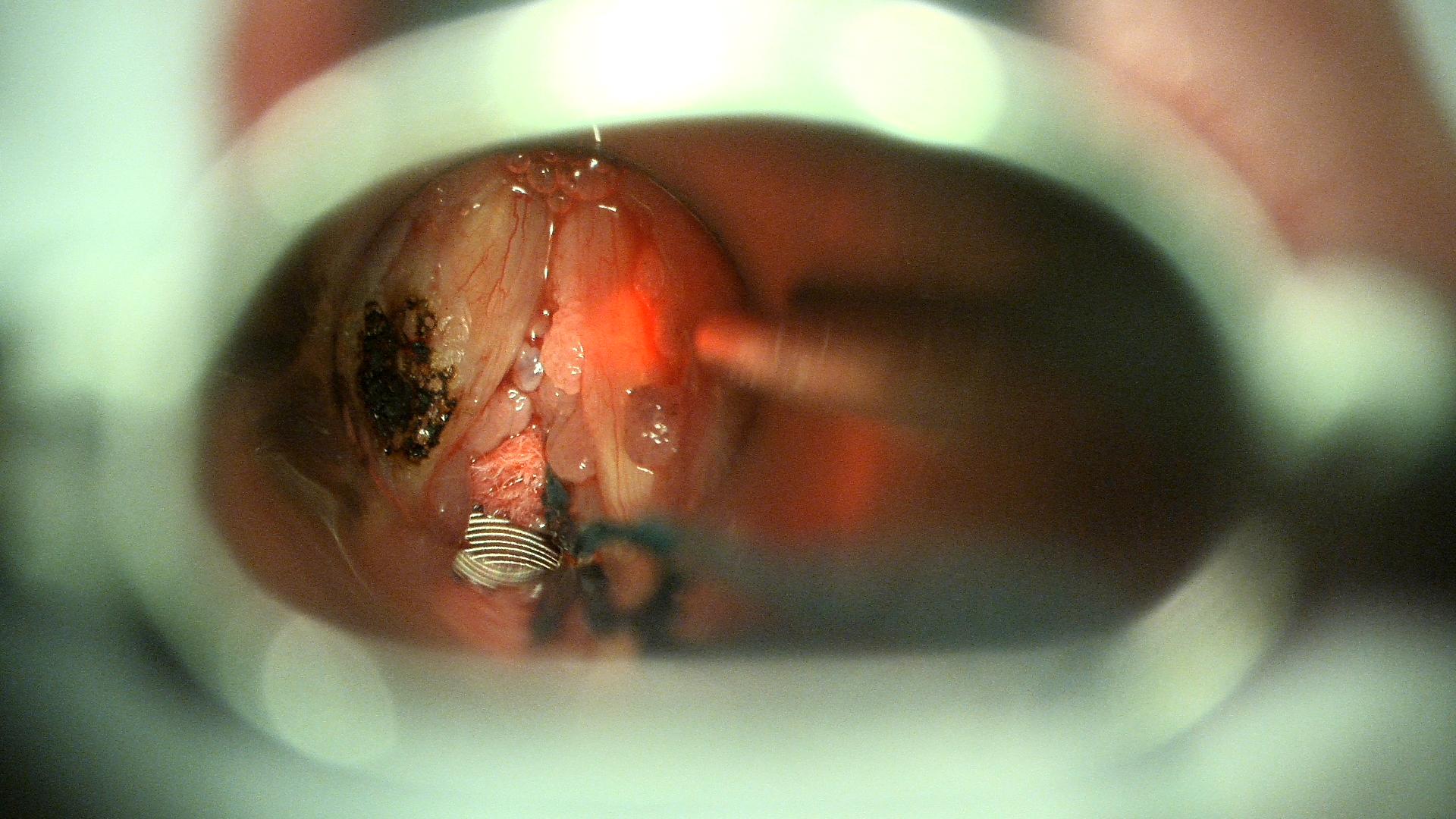 "Papilomatosis laríngea. Imagen tomada durante cirugía de resección mediante láser CO2.
