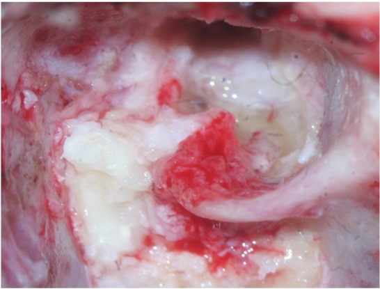 Fig. 1 Nervio facial erosionado por colestatoma intrapetroso