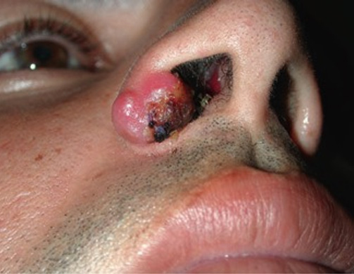 Carcinoma Epidermoide de ala nasal derecha